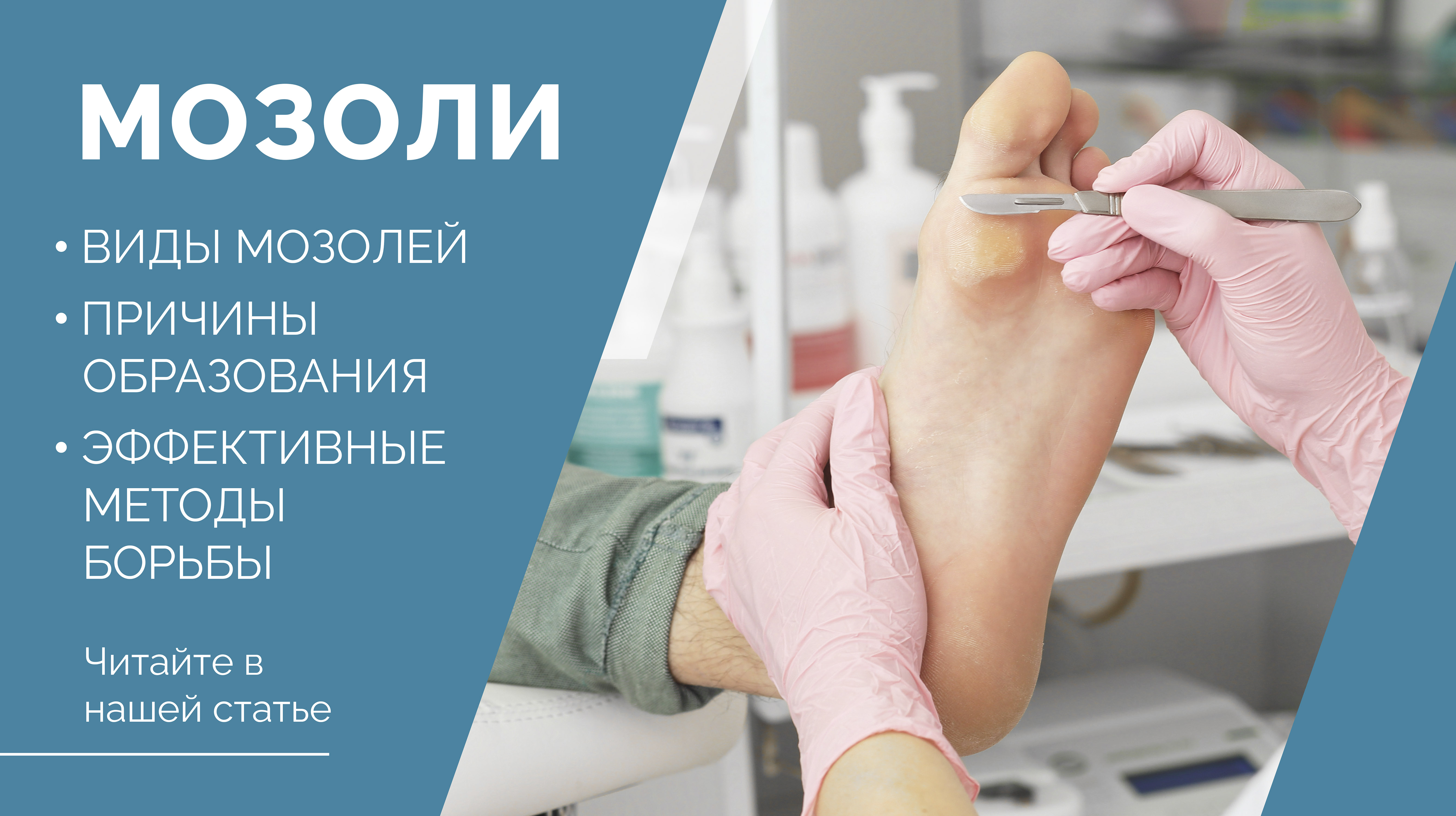 Причины образования мозолей и эффективные методы борьбы с ними.<